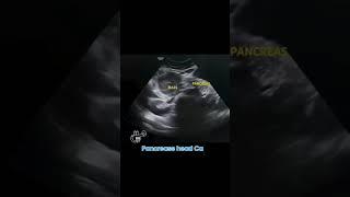 pancreatic head cancer#imaging #ultrasound #medicalimaging#learning #cancer#doctor #viral #medicine
