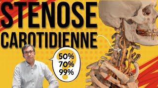 Sténose carotidienne : comment la confirmer et l'analyser avec l'angioscanner