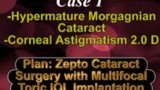 Zepto Cataract Surgery & Multifocal Toric IOL in Hypermature Morgagnian Cataract Dr Suresh K Pandey