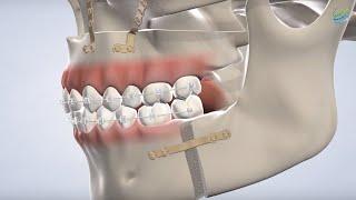 Orthognathic Surgery at Oral Surgery Services, Metairie, LA