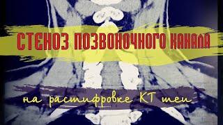 ВТОРИЧНЫЙ СТЕНОЗ позвоночного канала на уровне С4 С5 С6  расшифровка КТ шейного отдела позвоночника