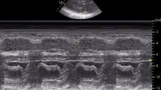 Alexandru Mischie - Obstructive Hypertrophic Cardiomyopathy with SAM systolic anterior movement