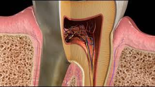 Abscess, Combined Lesion