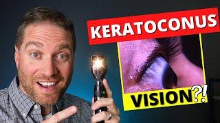 What Is Vision Like With Keratoconus And Irregular Astigmatism?