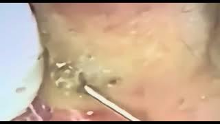 Big blackheads/ Removal Blackheads️