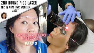 Another Microblading Removal Session: What worked and What didn't-Part 3