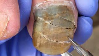 My Toenails Are Almost All Black, Need To Be Fixed!【Dr  Liu's Pedicur】