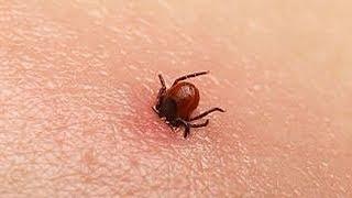 How to remove a tick the easy way. Tick Key Review - Tick Remover review.