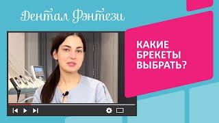 Какие брекеты выбрать