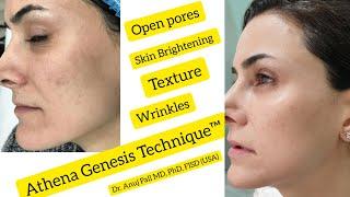 Athena Genesis Technique™ for pigmentation, open pores & rejuvenation