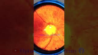 Retinitis pigmentosa | bone spicules | narrowed retinal vessels | Fundus | Short Video 211  #viral