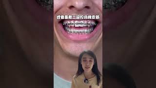 牙齒矯正到底能不能改善後縮的小下巴#戴牙套#臉型