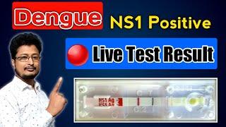 Dengue NS1 Positive | Dengue Patient | Dengue Fever | Dengue Test Live | #shorts