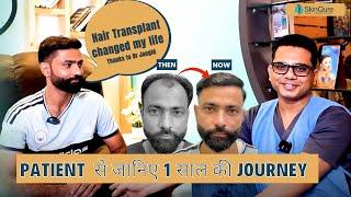 Best Hair transplant result  | Hair Transplant in Delhi | Dr Jangid | SkinQure