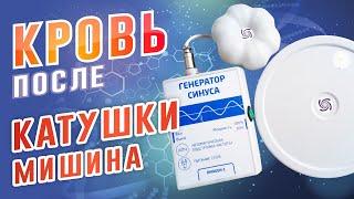 Катушка Мишина, что это? Как повлияла на кровь?