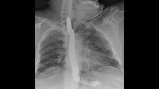 Dynamic Digital Radiology Retrospective View of Esophagus: Esophagogastroduodenoscopy (SEGD) part 2