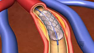 Animation - Coronary stent placement