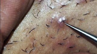 INGROWN HAIR REMOVAL #21