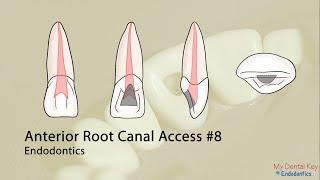 PASS THE CDCA - Anterior Endo Access | My Dental Key
