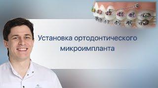 Установить ортодонтический микроимплант за 1 минуту. Стоимость. Недорогой.