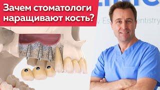 Синус-лифтинг при имплантации зубов / Как проводится синус-лифтинг?