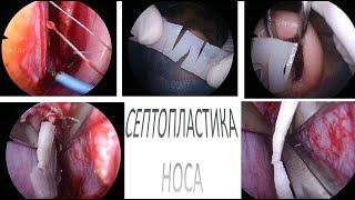 Септопластика перегородки носа с экстракорпоральным моделированием аутохряща ЛОР операция