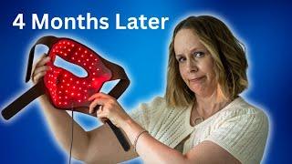 JOVS 4D Laser Red Light Therapy Mask 4 months later