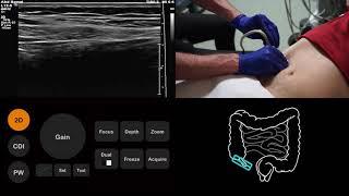 Ultrasound Tutorial: Appendix/Appendicitis (non-audio, text described version) | Radiology Nation