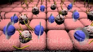 Bacterial Meningitis - fulminant -  video - Animation by Cal Shipley, M.D.