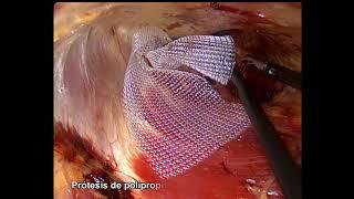 Endolich - Endoscopic Lichtenstein technique. Dr Pablo Medina