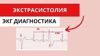 Экстрасистолия. Предсердные и желудочковые экстрасистолы. ЭКГ диагностика.