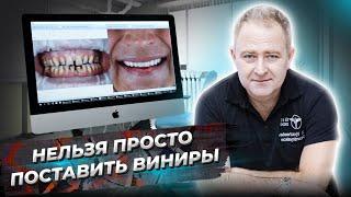 НЕЛЬЗЯ просто поставить ВИНИРЫ. ЧТО НУЖНО сделать перед установкой виниров. Установка виниров (16+)