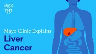 Mayo Clinic Explains Liver Cancer