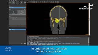 How to Create a 3D Model OF the Cranium & Mandible | Materialise Mimics inPrint Tutorial