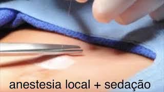 A Moderna Cirurgia de Hérnia Inguinal com Tela Tridimensional Mini-invasiva com Anestesia Local