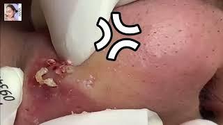 Super Hard Nose Blackheads removal Satisfying !   Anna Facial Treatment   002