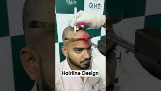 Amazing Hair Transplant Surgery | Latest Fue Technique #shorts #viral #hair transplant