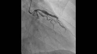 Figure 1:  Initial Left Circumflex Artery - complete occlusion with ectasia.