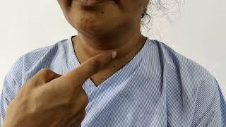 Unilateral dancing carotid in Takayasu's arteritis ; Dept Of Medicine; JNMC ; Sawangi