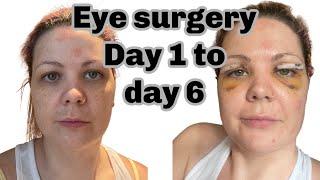 My Blepharoplasty experience eyelid surgery and recovery day 1 to 6