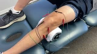 Example Of Electro DN For Knee OA | Orlando FL | Pursuit Physical Therapy