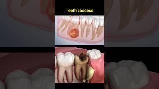 Tooth abscess problem #dentist #dentisty #teeth #dental