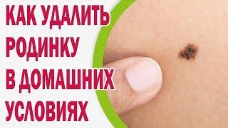 Как удалить родинку в домашних условиях