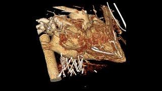 Cardiac Tamponade From Inferior Vena Cava (IVC) Stent Fracture