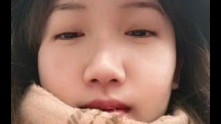 脑门长痘了 带个帽子遮一遮