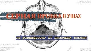 БОЛЬ в ухе и СЕРНАЯ ПРОБКА в ухе на РАСШИФРОВКЕ КТ височных костей ВТОРОЕ МНЕНИЕ по снимкам DICOM