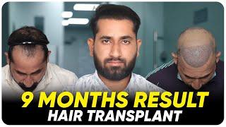 Hair Transplant in Turkey | Best Results & Cost of Hair Transplant in Turkey