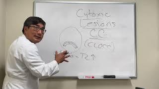 CLOCC (cytotoxic lesion of the corpus callosum)