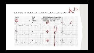 Using R Wave Progression