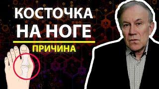 Косточка на ноге. Причина | Анатолий Донской | Энергия мысли